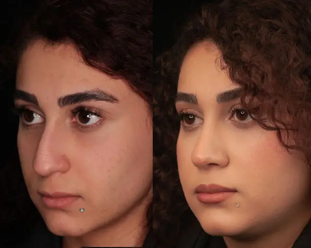 رینوپلاستی دکتر خسروی