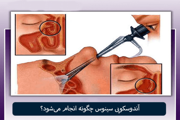 آندوسکوپی سینوس چگونه انجام می شود؟
