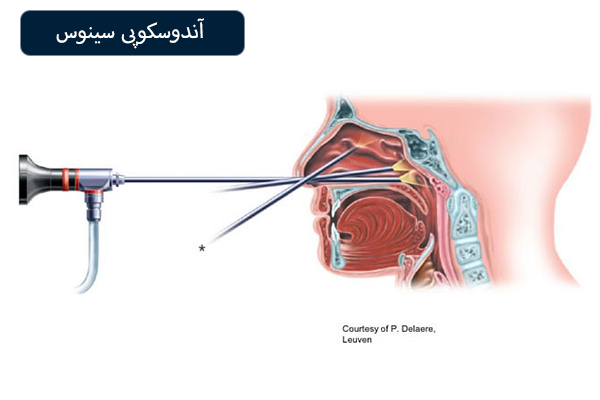 آندوسکوپی سینوس
