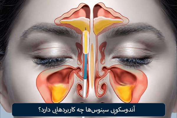 آندوسکوپی سینوس ها چه کاربردهایی دارد؟
