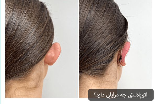 اتوپلاستی چه مزایایی دارد؟