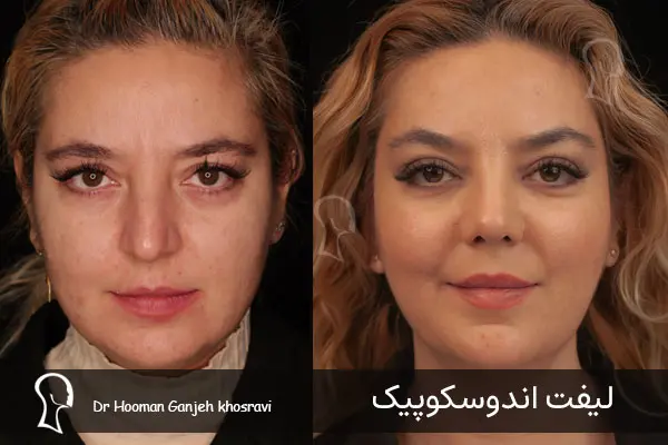 لیفت اندوسکوپیک