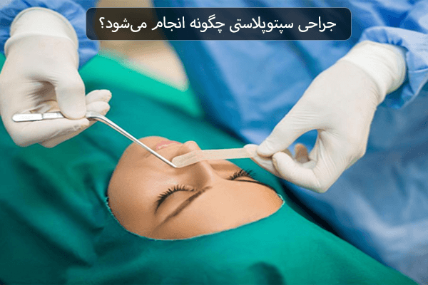 جراحی سپتوپلاستی چگونه انجام می شود؟