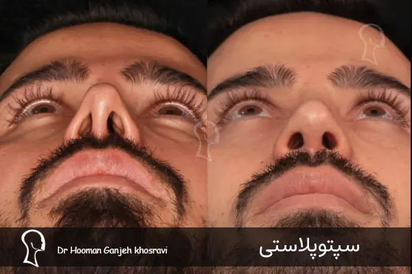 سپتوپلاستی