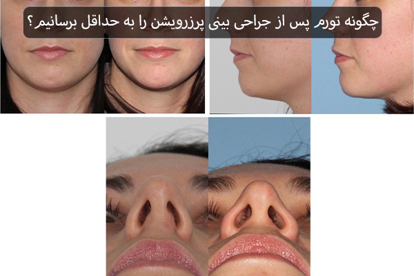 چگونه تورم پس از جراحی بینی پرزرویشن را به حداقل برسانیم؟