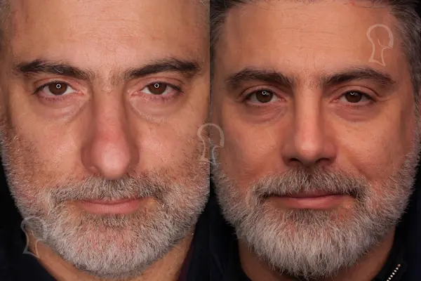 مزایای جراحی بینی به روش پرزرویشن