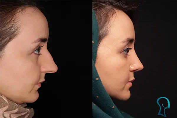 راهنمای مراجعه به دکتر برای جراحی رینوپلاستی