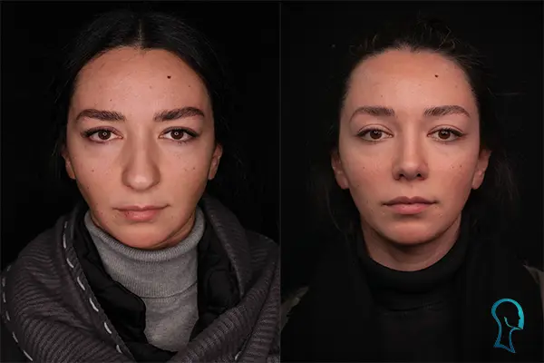 جراحی ترمیم بینی