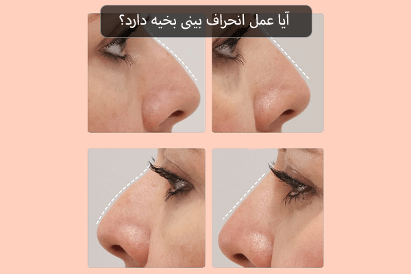 آیا عمل انحراف بینی بخیه دارد؟ 