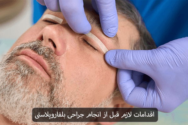 اقدامات لازم قبل از انجام جراحی بلفاروپلاستی