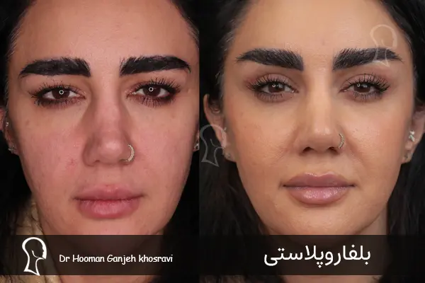 بلفاروپلاستی