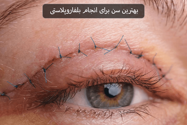بهترین سن برای انجام بلفاروپلاستی