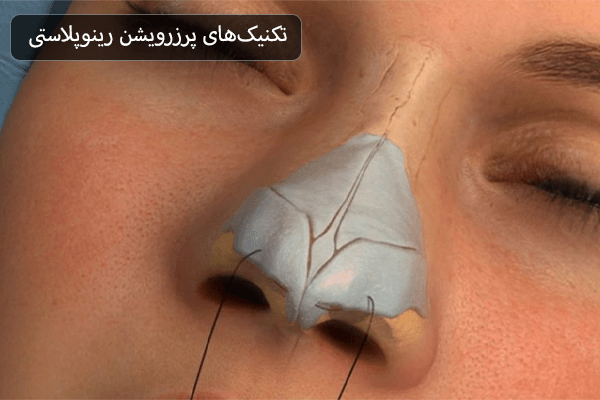  انواع روش پرزرویشن رینوپلاستی