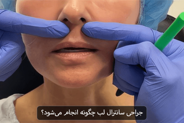 جراحی سانترال لب چگونه انجام می شود؟