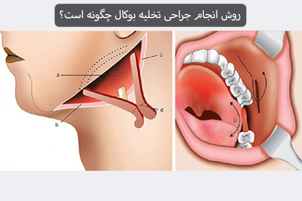 روش انجام جراحی تخلیه بوکال چگونه است؟