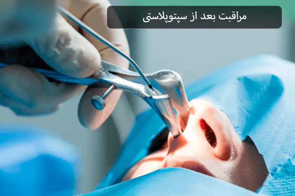 مراقبت بعد از سپتوپلاستی