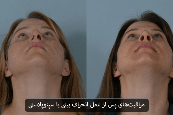مراقبت های پس از عمل انحراف بینی یا سپتوپلاستی