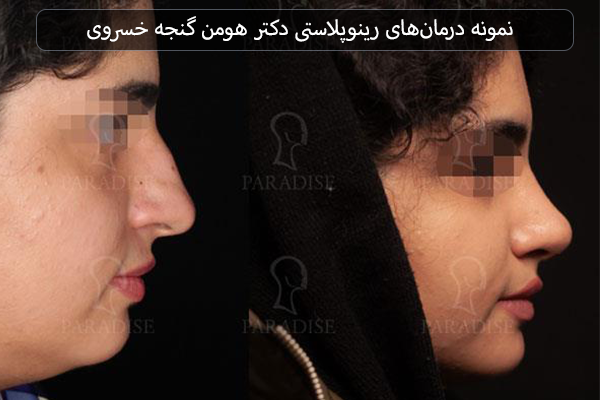 نمونه درمان‌های رینوپلاستی دکتر هومن گنجه خسروی