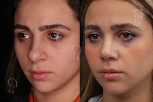 جراحی بینی گوشتی