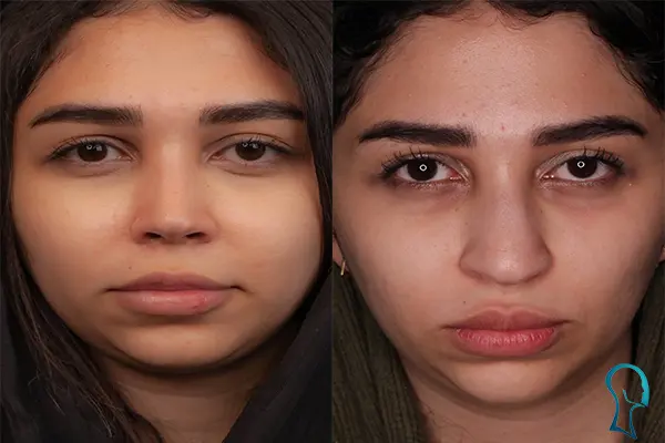 رینوپلاستی بینی طبیعی
