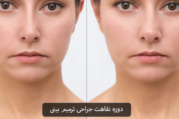 دوره نقاهت جراحی ترمیم بینی