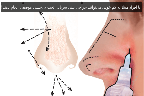 آیا افراد مبتلا به کم خونی می‌توانند جراحی بینی سرپایی تحت بی‌حسی موضعی انجام دهند؟