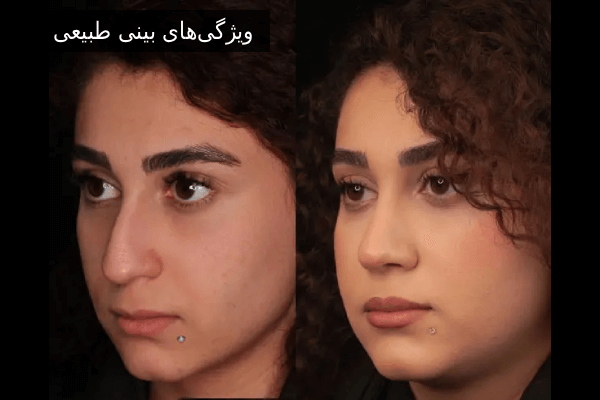 ویژگیهای بینی طبیعی