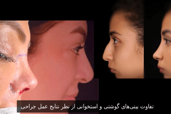 تفاوت بینیهای گوشتی و استخوانی از نظر نتایج عمل جراحی