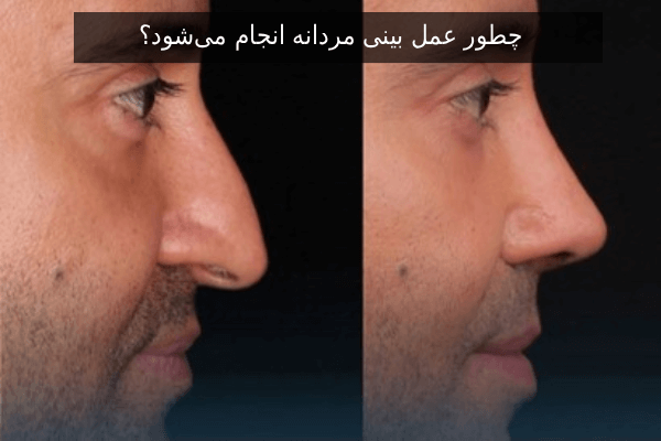 چطور عمل بینی مردانه انجام میشود؟