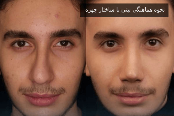 نحوه هماهنگی بینی با ساختار چهره