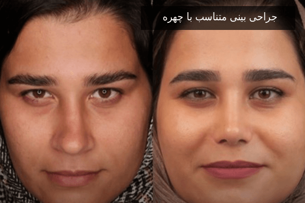 جراحی بینی متناسب با چهره