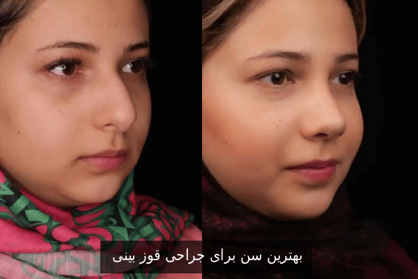 بهترین سن برای جراحی قوز بینی