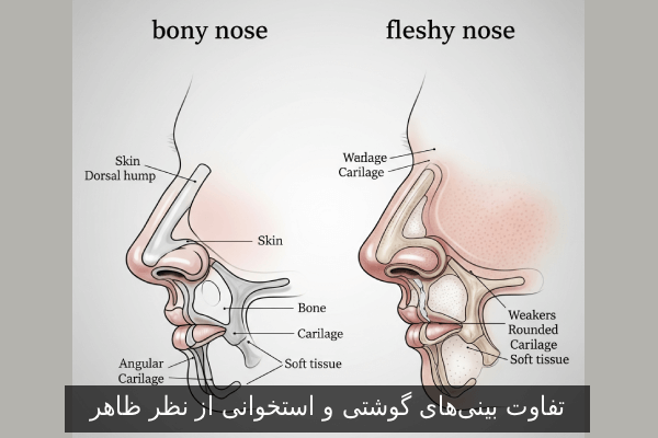 تفاوت بینیهای گوشتی و استخوانی از نظر ظاهر