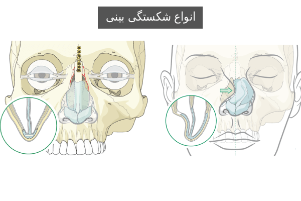 انواع شکستگی بینی