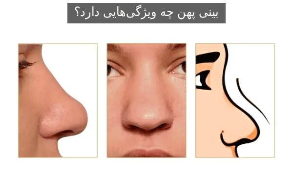 بینی پهن چه ویژگی‌هایی دارد؟