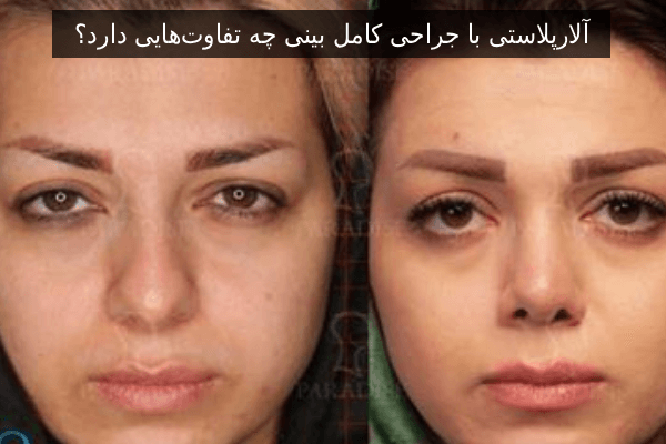 آلارپلاستی با جراحی کامل بینی چه تفاوت‌هایی دارد؟