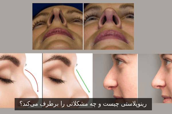 رینوپلاستی چیست و چه مشکلاتی را برطرف می‌کند؟