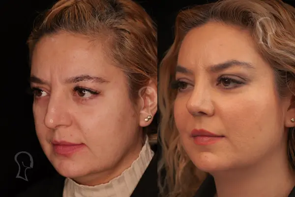 چه کسانی گزینه‌های مناسبی برای لیفت آندوسکوپیک صورت هستند؟