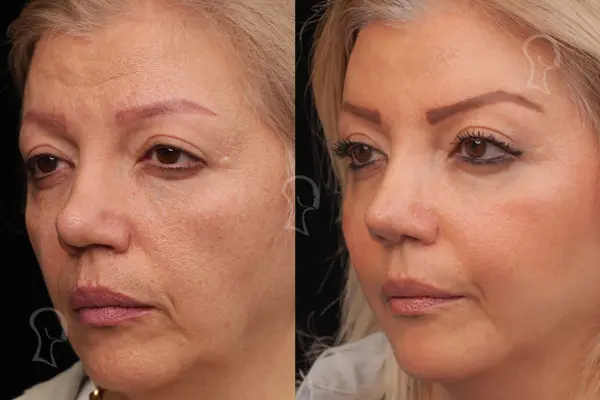چه کسانی گزینه‌های مناسبی برای لیفت آندوسکوپیک صورت هستند؟