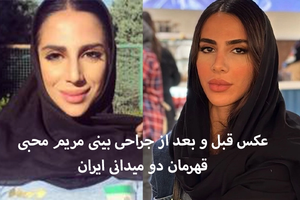 جراحی بینی مریم محبی قهرمان دو میدانی کشور