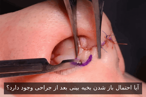 آیا احتمال باز شدن بخیه بینی بعد از جراحی وجود دارد؟