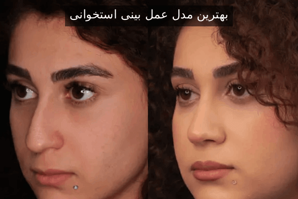 بهترین مدل عمل بینی استخوانی