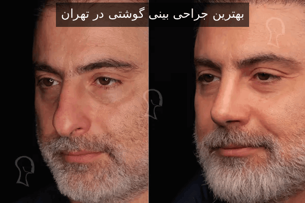 بهترین جراحی بینی گوشتی در تهران