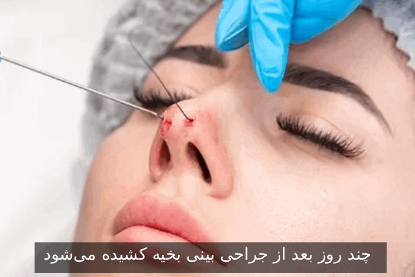 چند روز بعد از جراحی بینی بخیه کشیده می‌شود