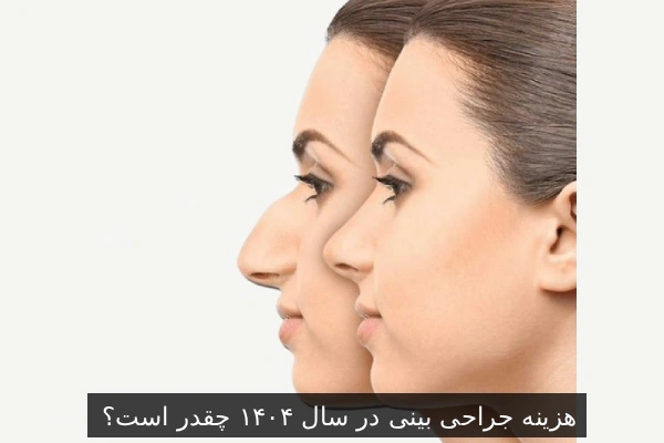 هزینه جراحی بینی در سال ۱۴۰۴ چقدر است؟