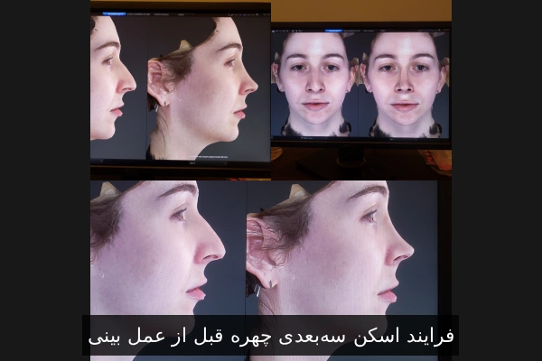 فرایند اسکن سه‌بعدی چهره قبل از عمل بینی