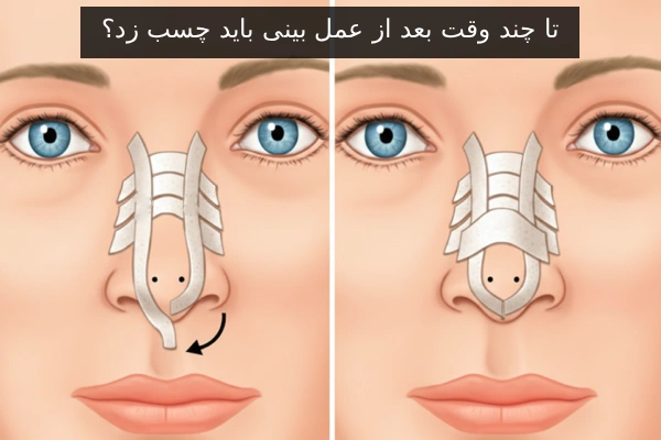 تا چند وقت بعد از عمل بینی باید چسب زد؟