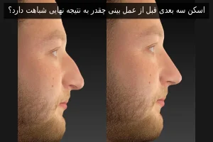 اسکن سه بعدی قبل از عمل بینی چقدر به نتیجه نهایی شباهت دارد؟