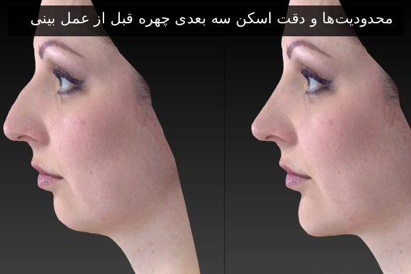 محدودیت‌ها و دقت اسکن سه بعدی چهره قبل از عمل بینی