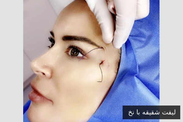 لیفت شقیقه با نخ